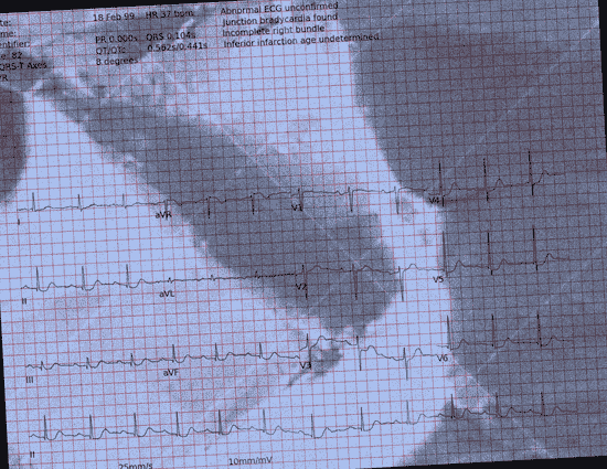 Normal ECG — PTB-XL