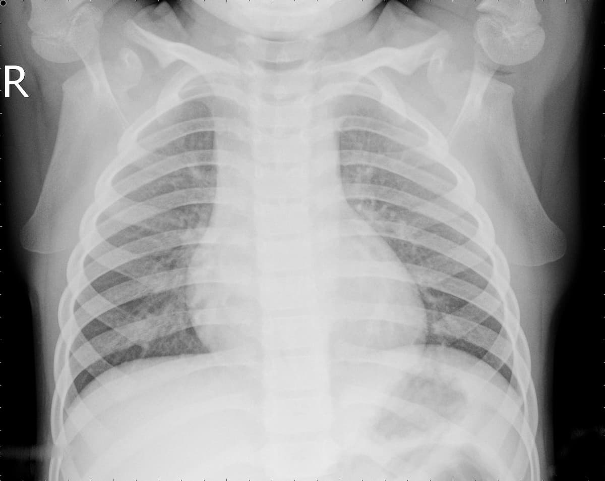 Radiografia Normal — NIH Chest X-ray14