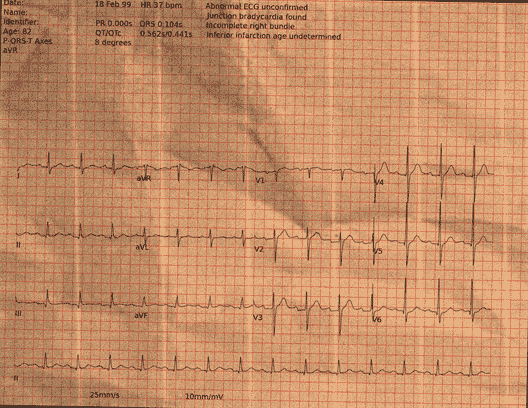 Normal ECG — PTB-XL