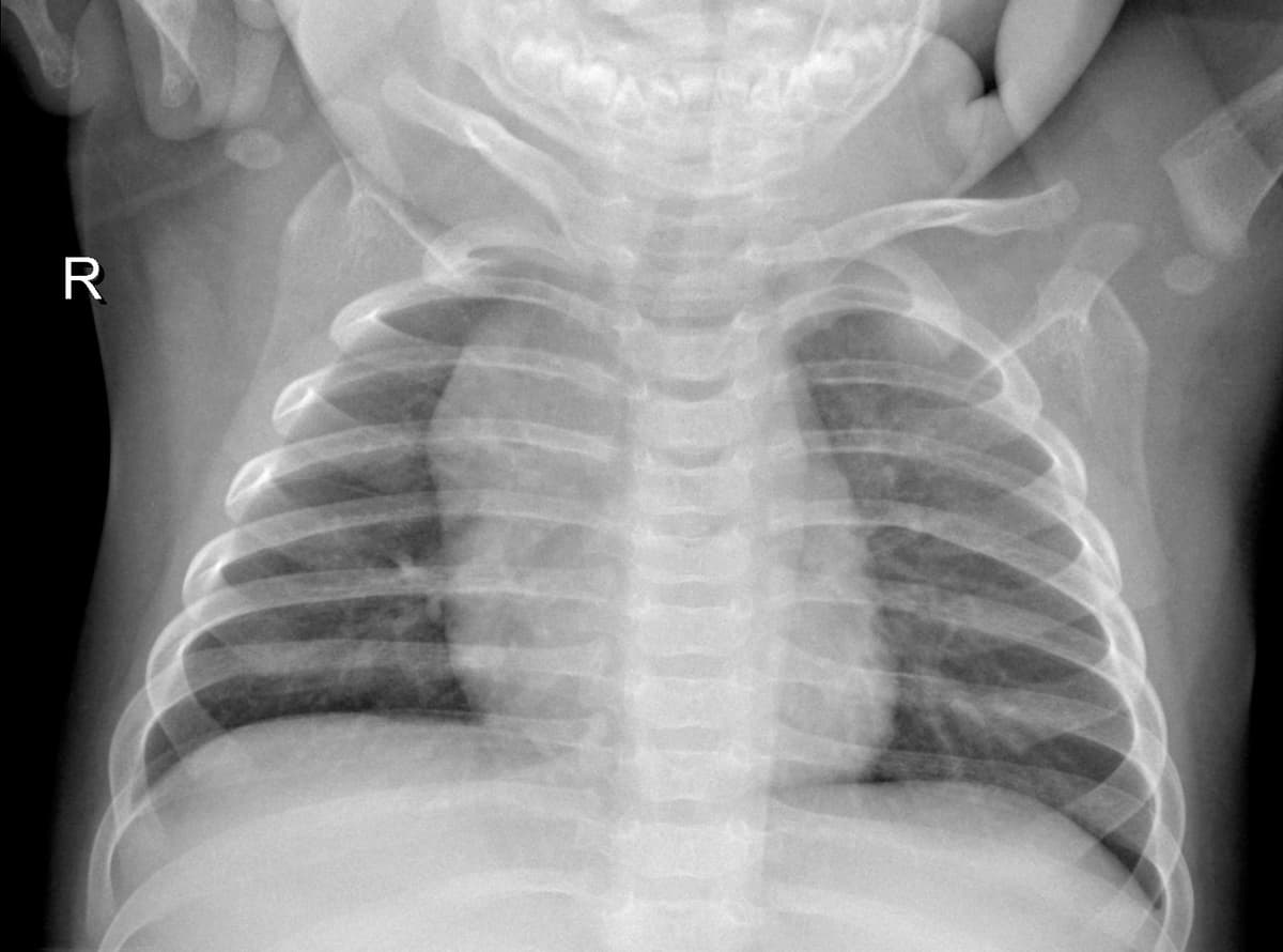 Radiografia Normal — NIH Chest X-ray14