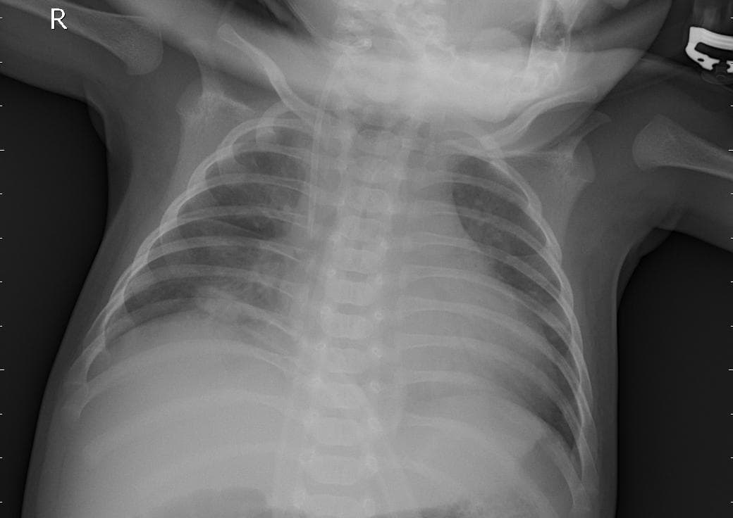 Pneumonia — NIH Chest X-ray14