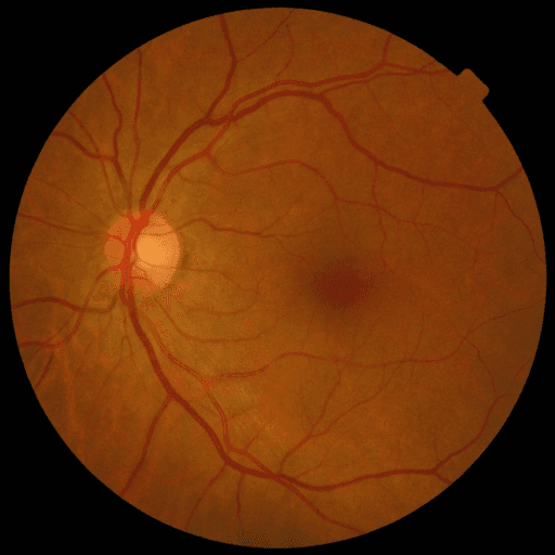 No Diabetic Retinopathy — MESSIDOR-2
