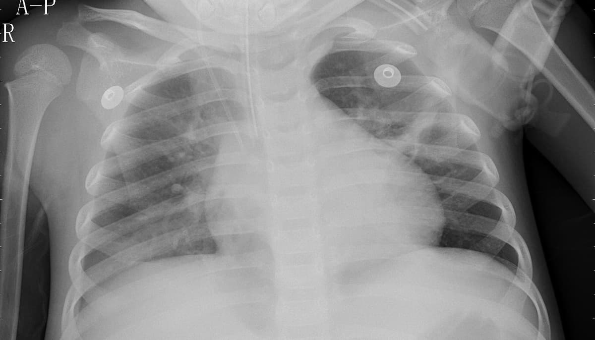 Pneumonia — NIH Chest X-ray14