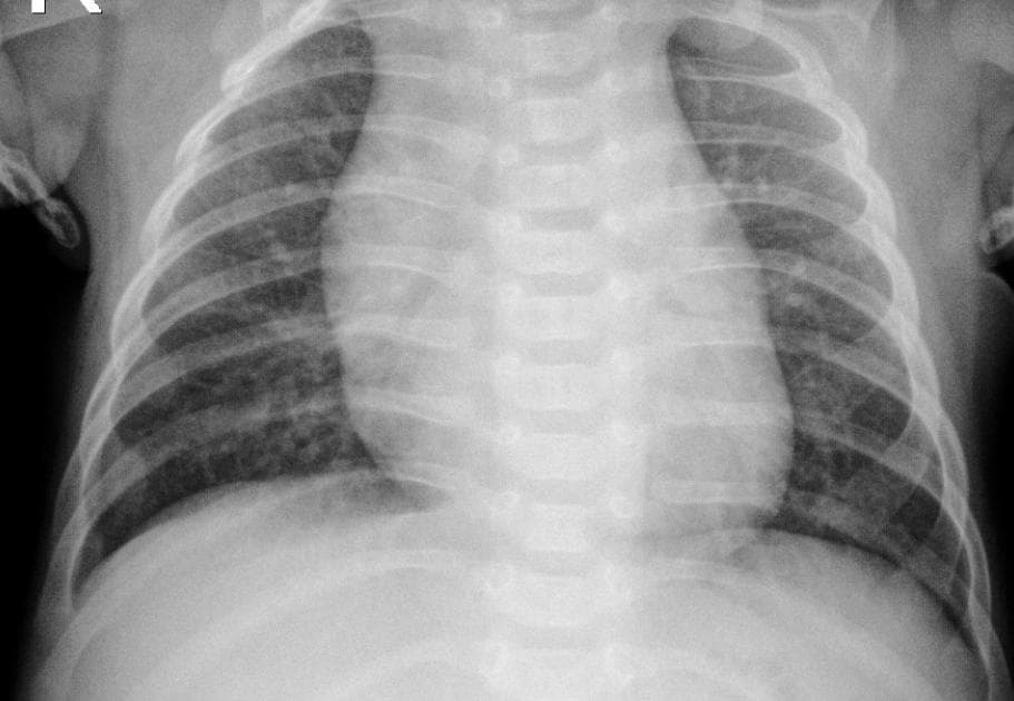 Pneumonia — NIH Chest X-ray14