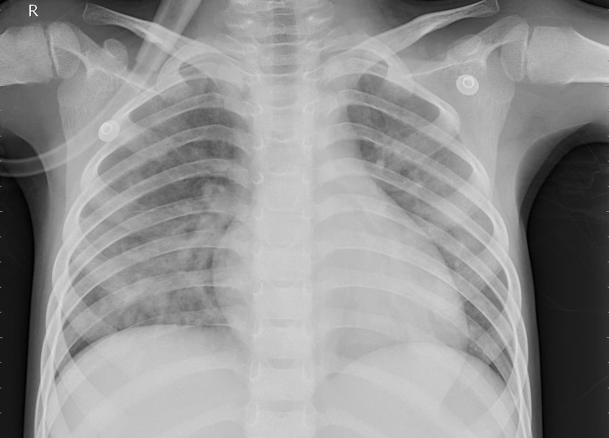 Pneumonia — NIH Chest X-ray14
