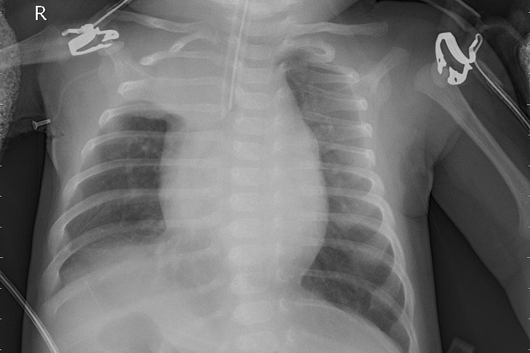 Pneumonia — NIH Chest X-ray14