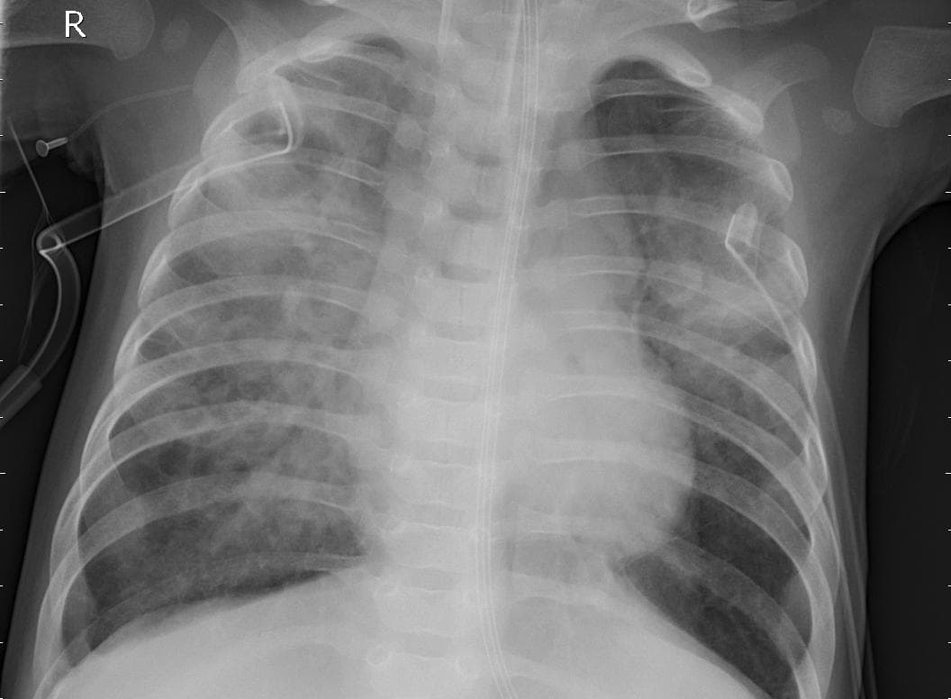 Pneumonia — NIH Chest X-ray14