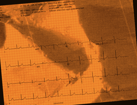Normal ECG — PTB-XL