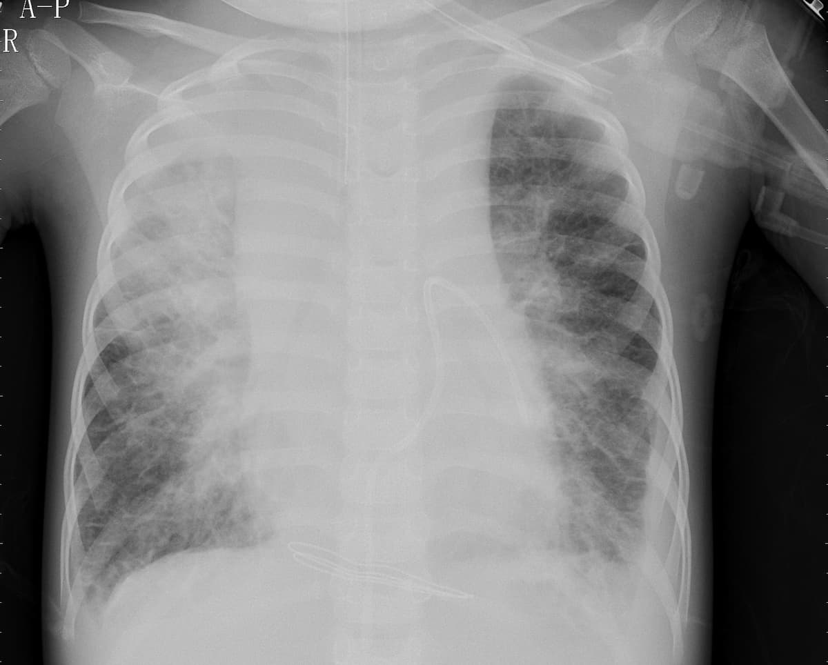 Pneumonia — NIH Chest X-ray14