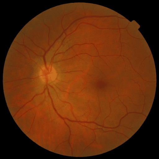 No Diabetic Retinopathy — MESSIDOR-2