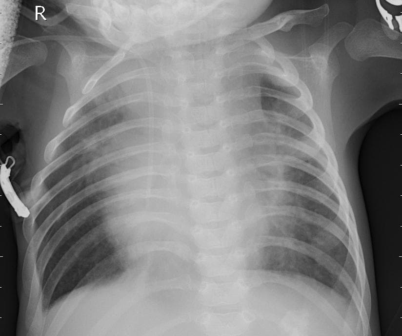 Pneumonia — NIH Chest X-ray14