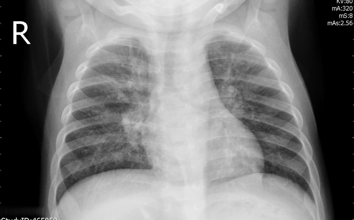 Pneumonia — NIH Chest X-ray14