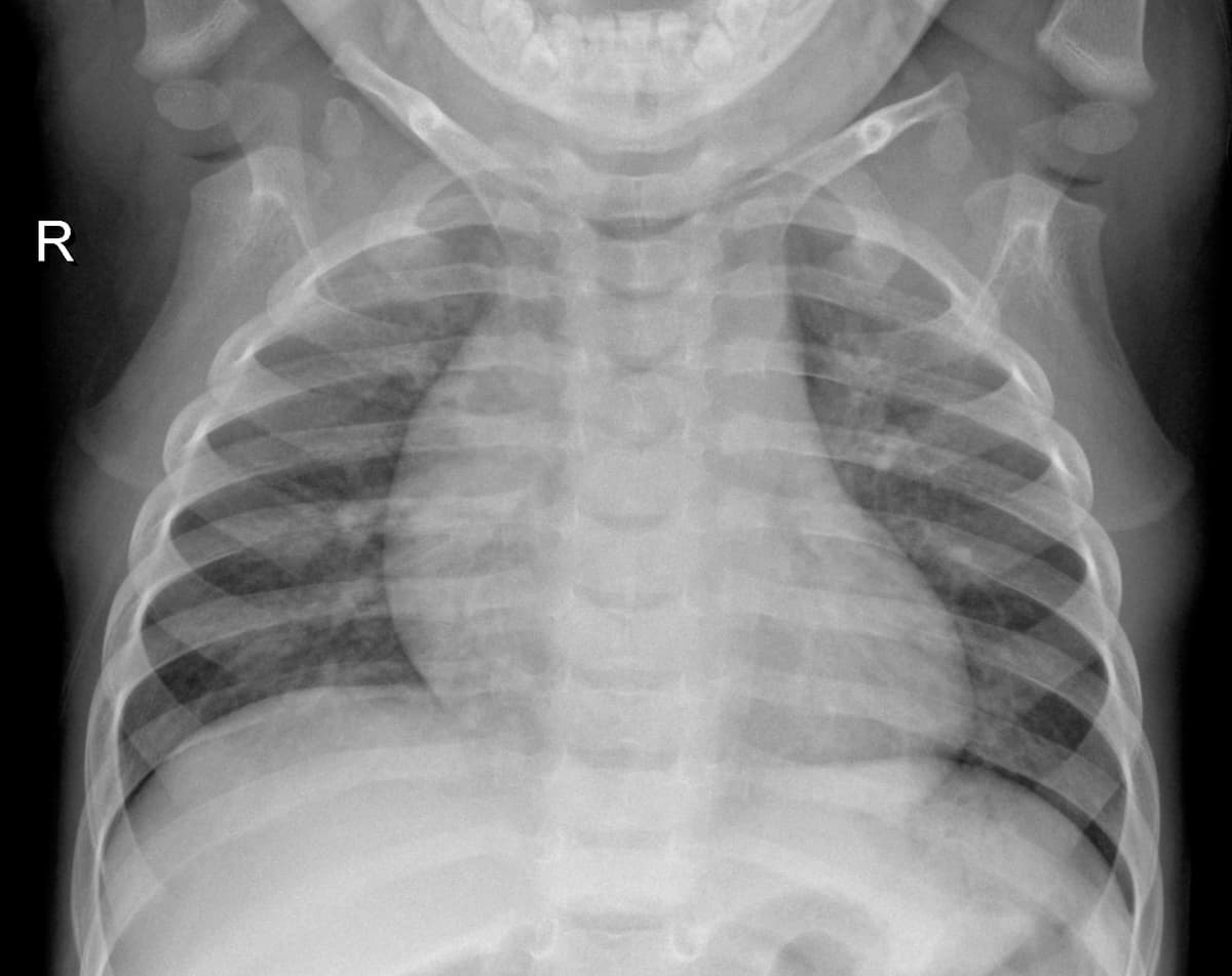 Radiografia Normal — NIH Chest X-ray14