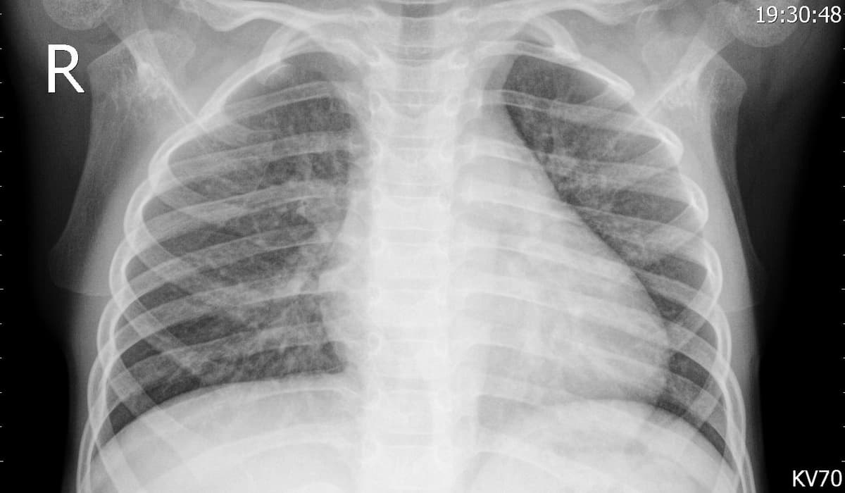 Pneumonia — NIH Chest X-ray14