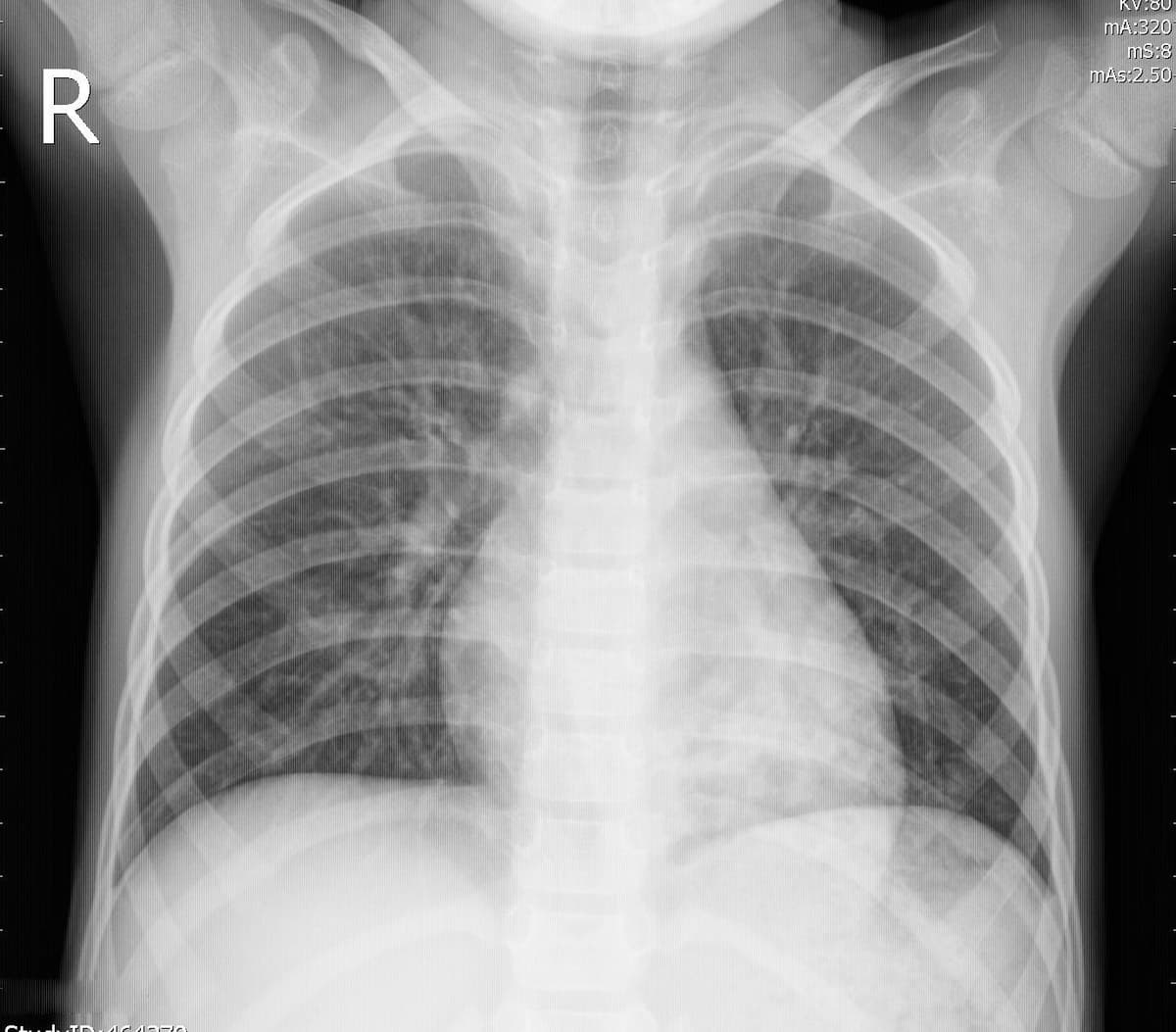 Pneumonia — NIH Chest X-ray14
