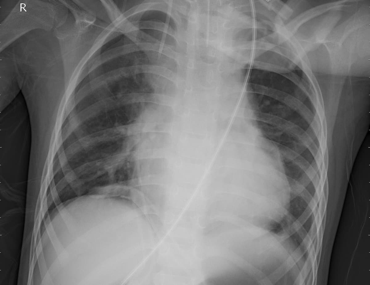 Pneumonia — NIH Chest X-ray14