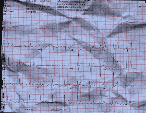 Normal ECG — PTB-XL