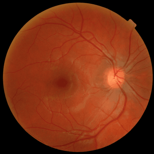 No Diabetic Retinopathy — MESSIDOR-2