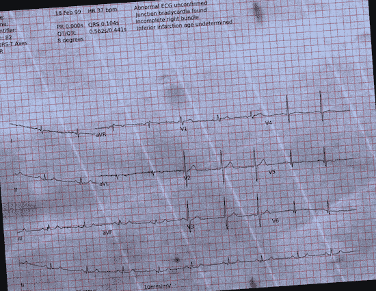 Normal ECG — PTB-XL