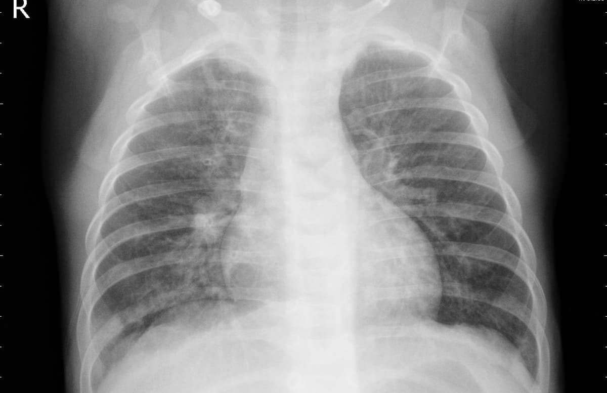 Pneumonia — NIH Chest X-ray14