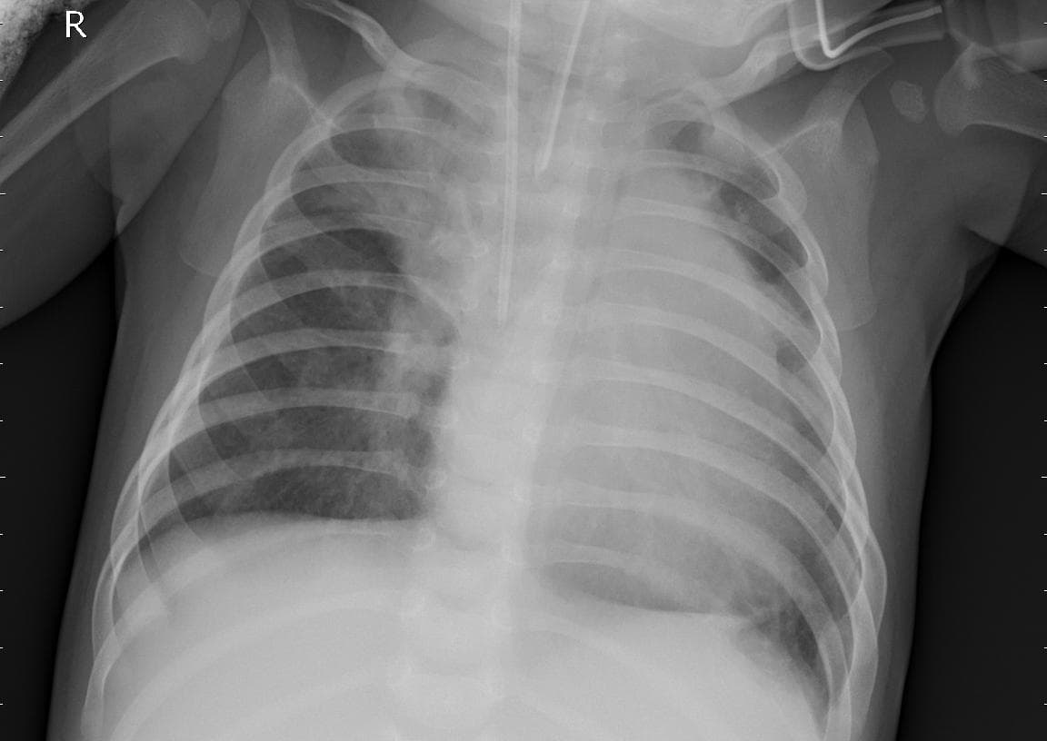 Pneumonia — NIH Chest X-ray14