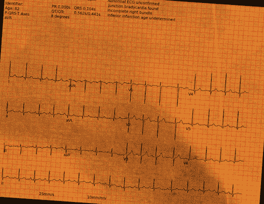 Normal ECG — PTB-XL