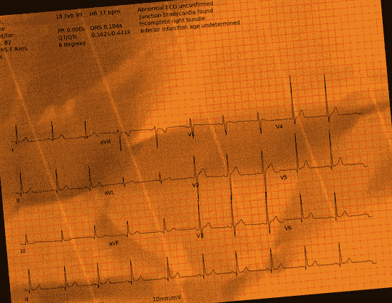 Normal ECG — PTB-XL