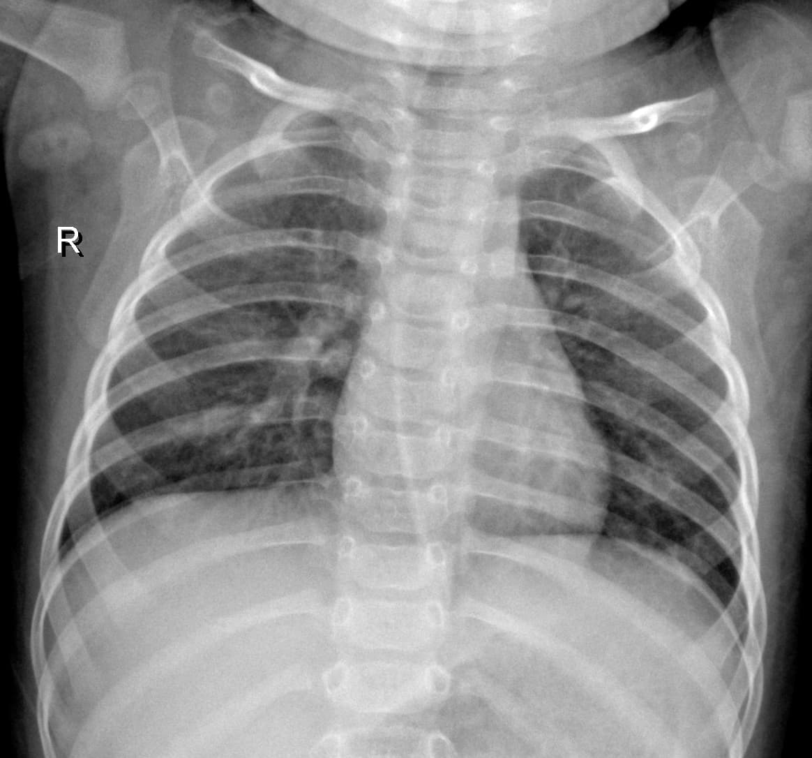Radiografia Normal — NIH Chest X-ray14