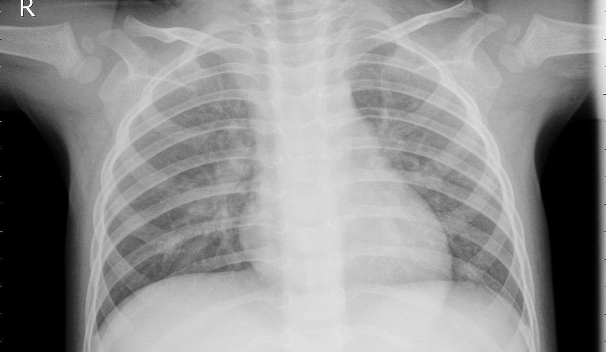 Pneumonia — NIH Chest X-ray14