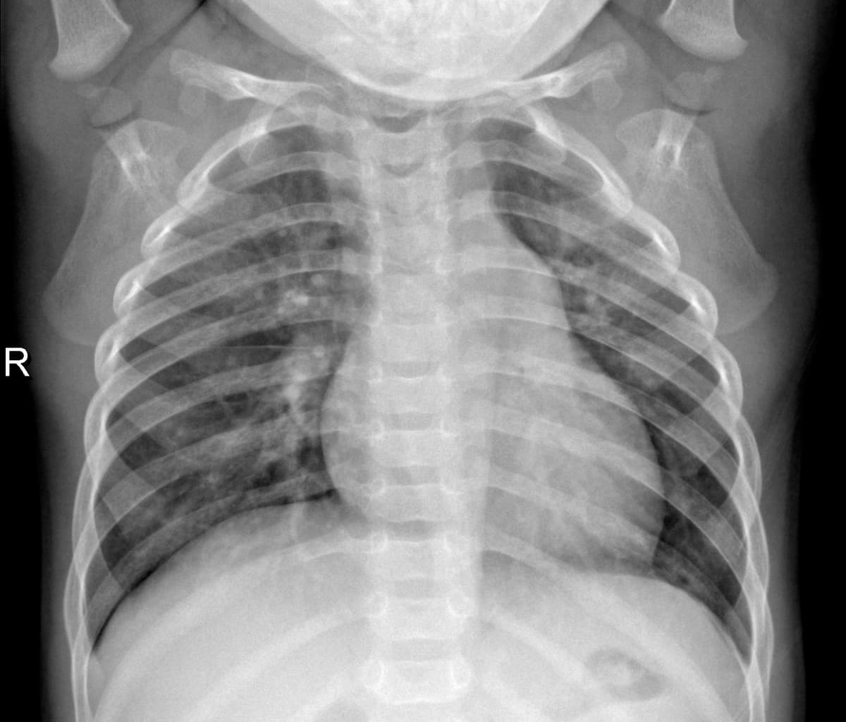 Radiografia Normal — NIH Chest X-ray14
