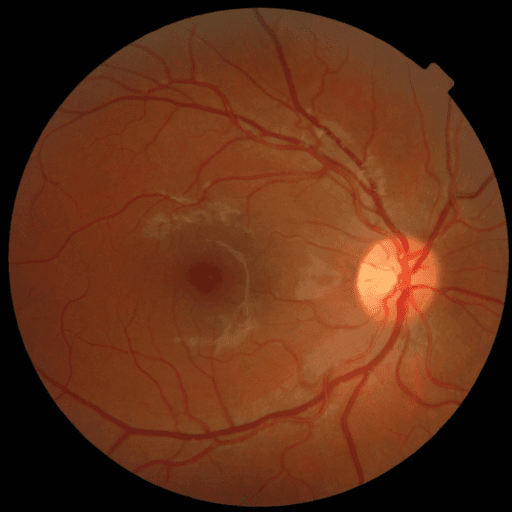Proliferative DR — MESSIDOR-2