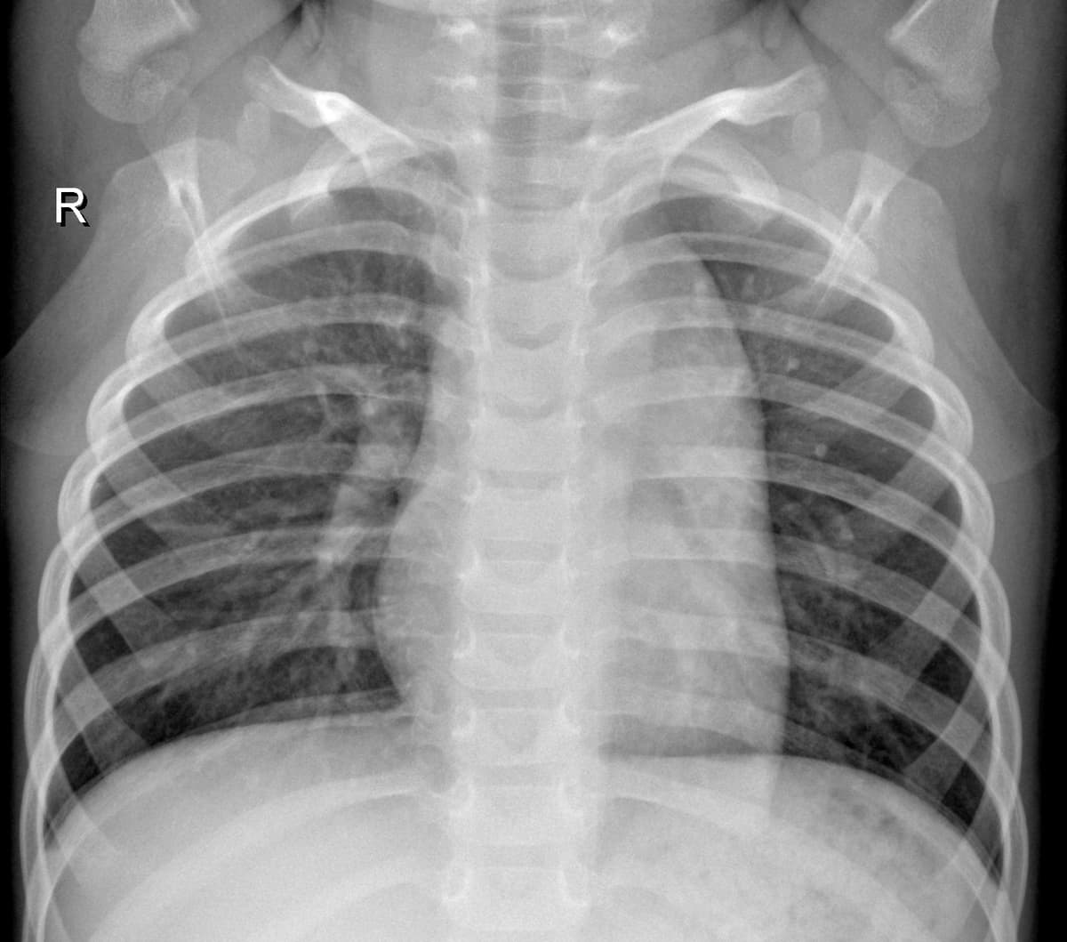 Radiografia Normal — NIH Chest X-ray14
