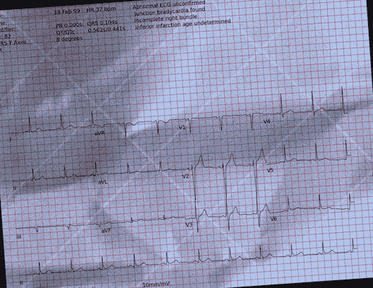 Normal ECG — PTB-XL