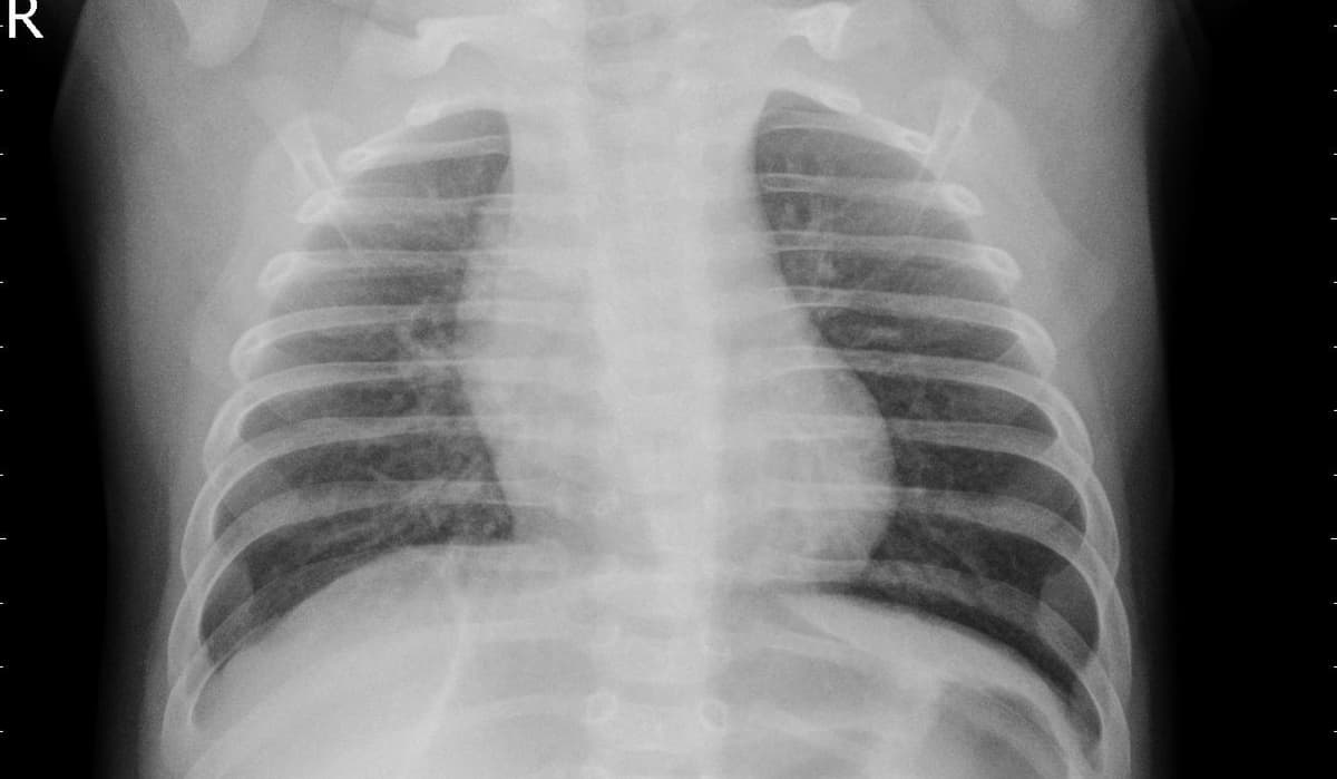 Pneumonia — NIH Chest X-ray14