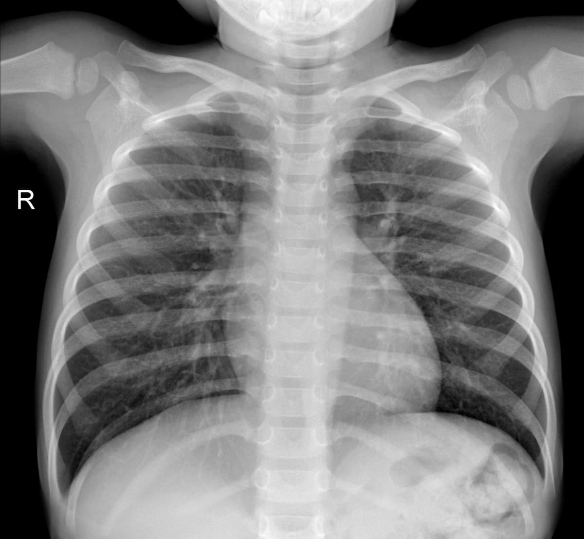 Radiografia Normal — NIH Chest X-ray14