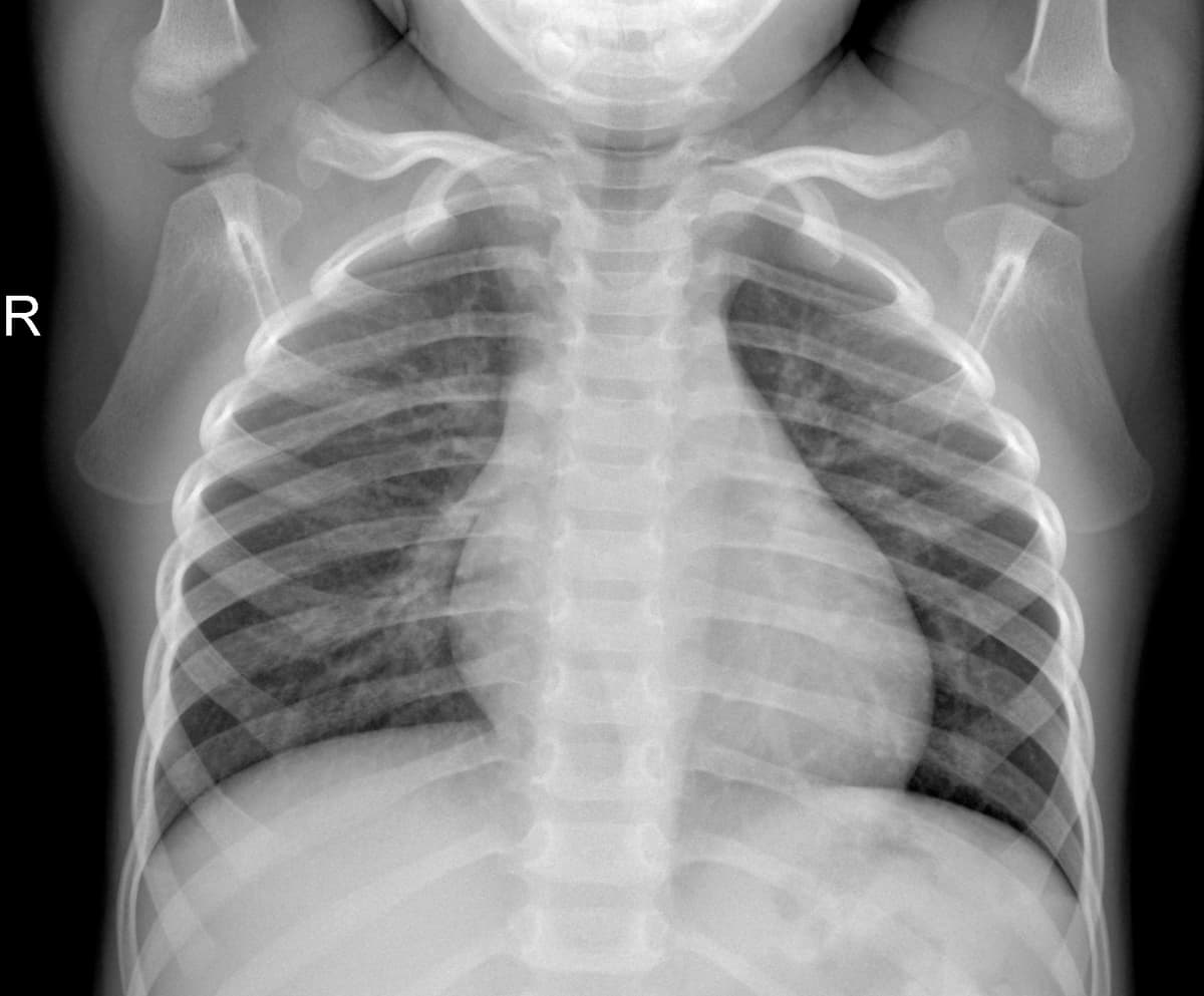 Radiografia Normal — NIH Chest X-ray14
