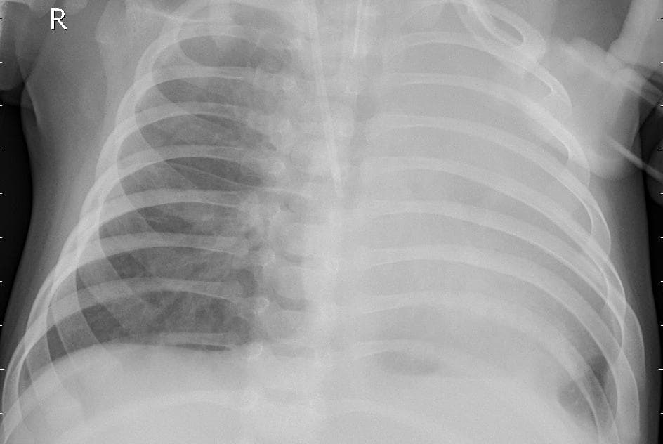 Pneumonia — NIH Chest X-ray14