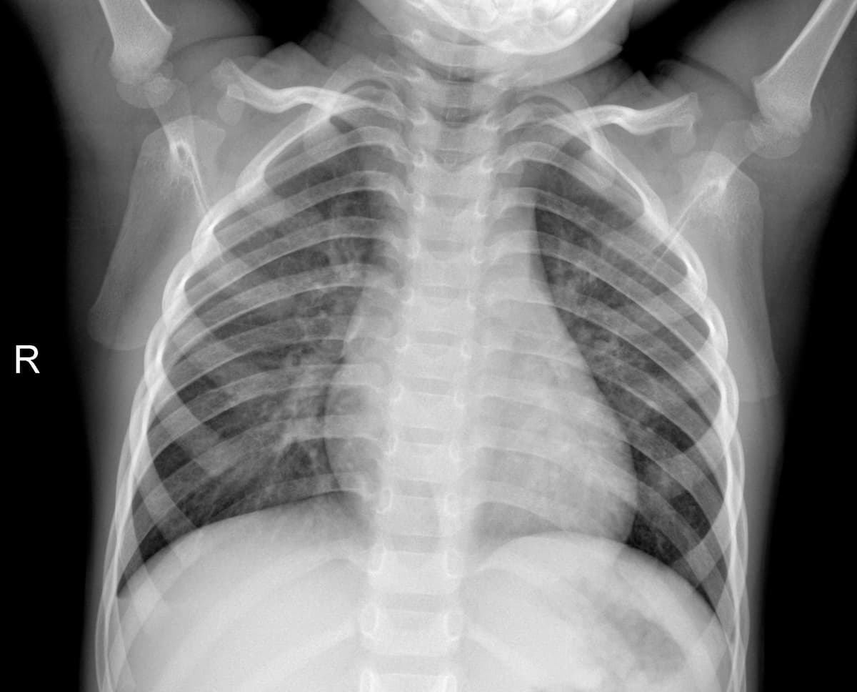 Radiografia Normal — NIH Chest X-ray14