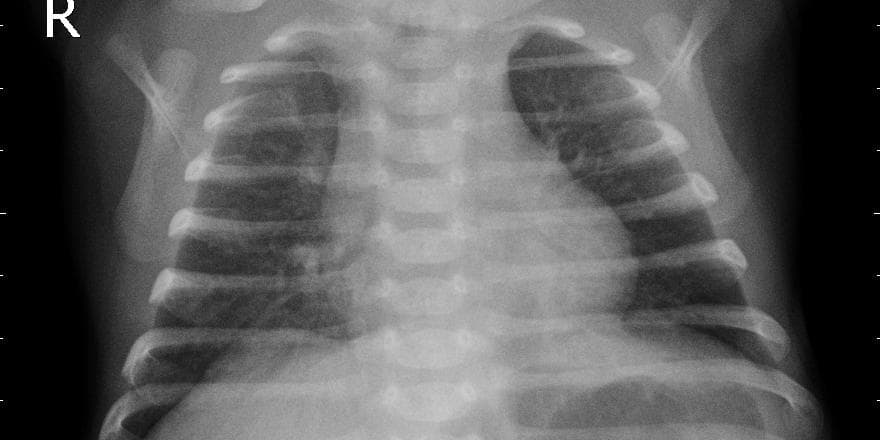 Pneumonia — NIH Chest X-ray14