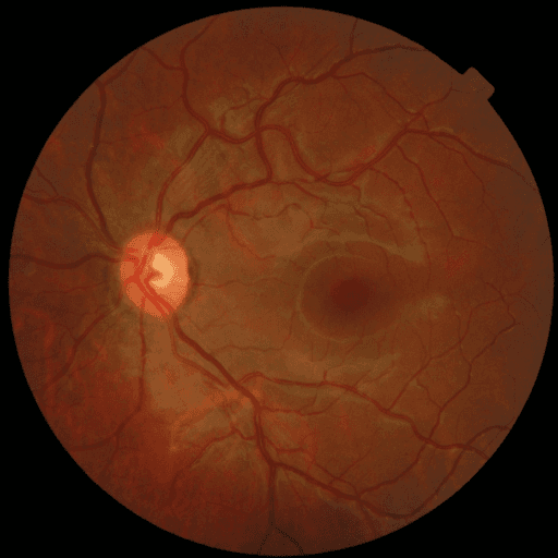 No Diabetic Retinopathy — MESSIDOR-2