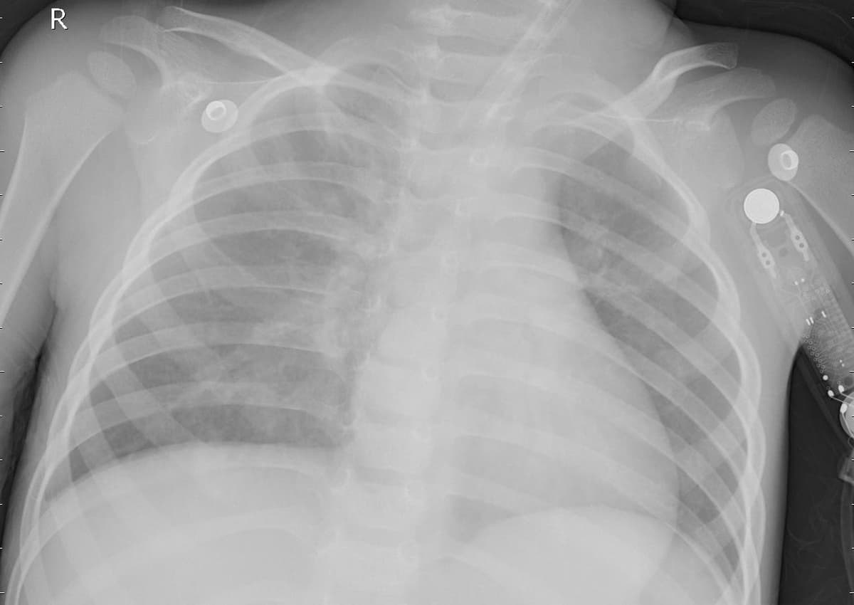 Pneumonia — NIH Chest X-ray14