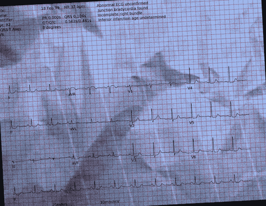 Normal ECG — PTB-XL