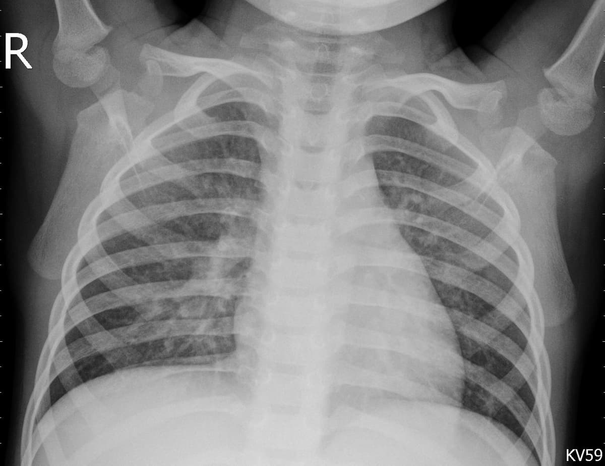 Pneumonia — NIH Chest X-ray14