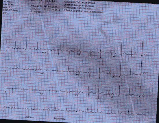 Normal ECG — PTB-XL