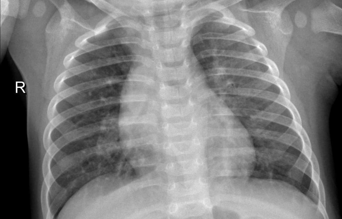 Pneumonia — NIH Chest X-ray14