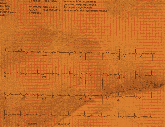 Normal ECG — PTB-XL