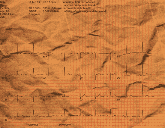 Normal ECG — PTB-XL