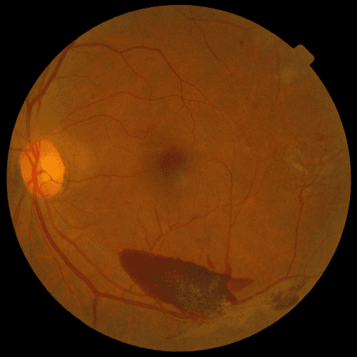 No Diabetic Retinopathy — MESSIDOR-2