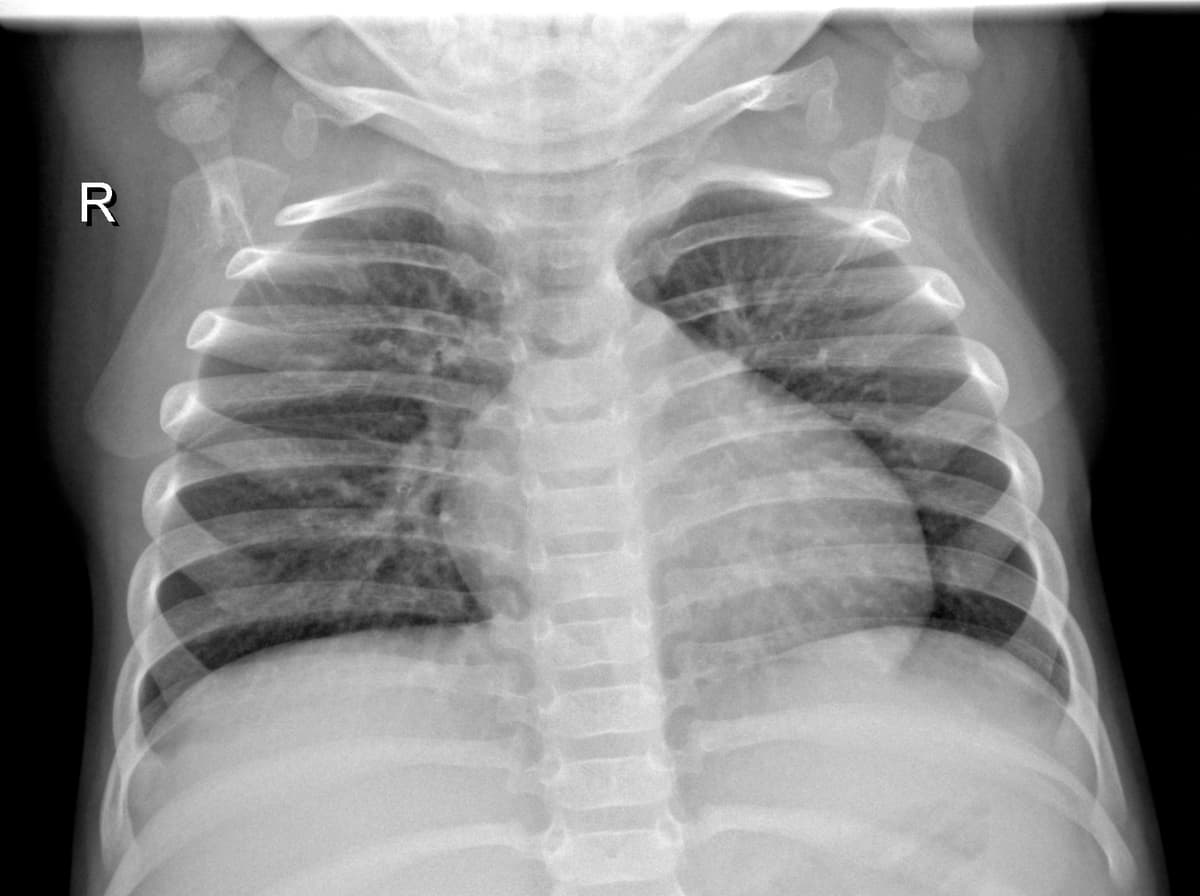 Radiografia Normal — NIH Chest X-ray14