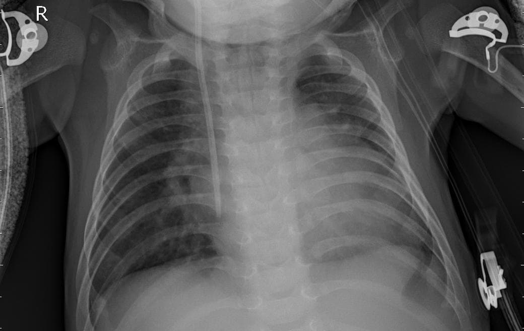 Pneumonia — NIH Chest X-ray14